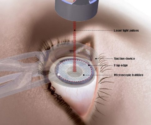 Tìm hiểu những thông tin cơ bản về mổ mắt cận