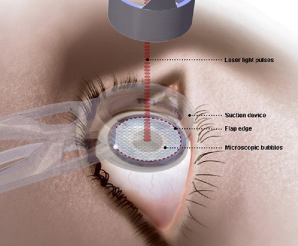 Tìm hiểu những thông tin cơ bản về mổ mắt cận