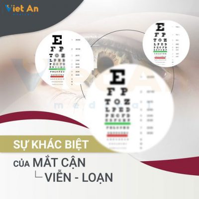 Khác nhau giữa Cận thị - Viễn thị - Loạn thị