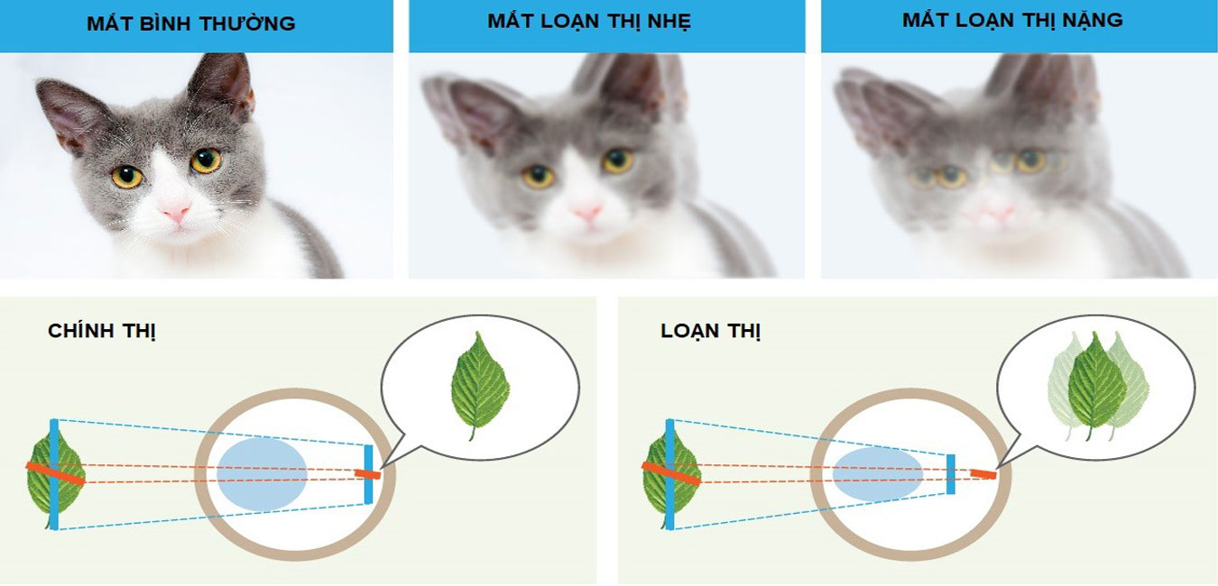 Các mức độ loạn thị