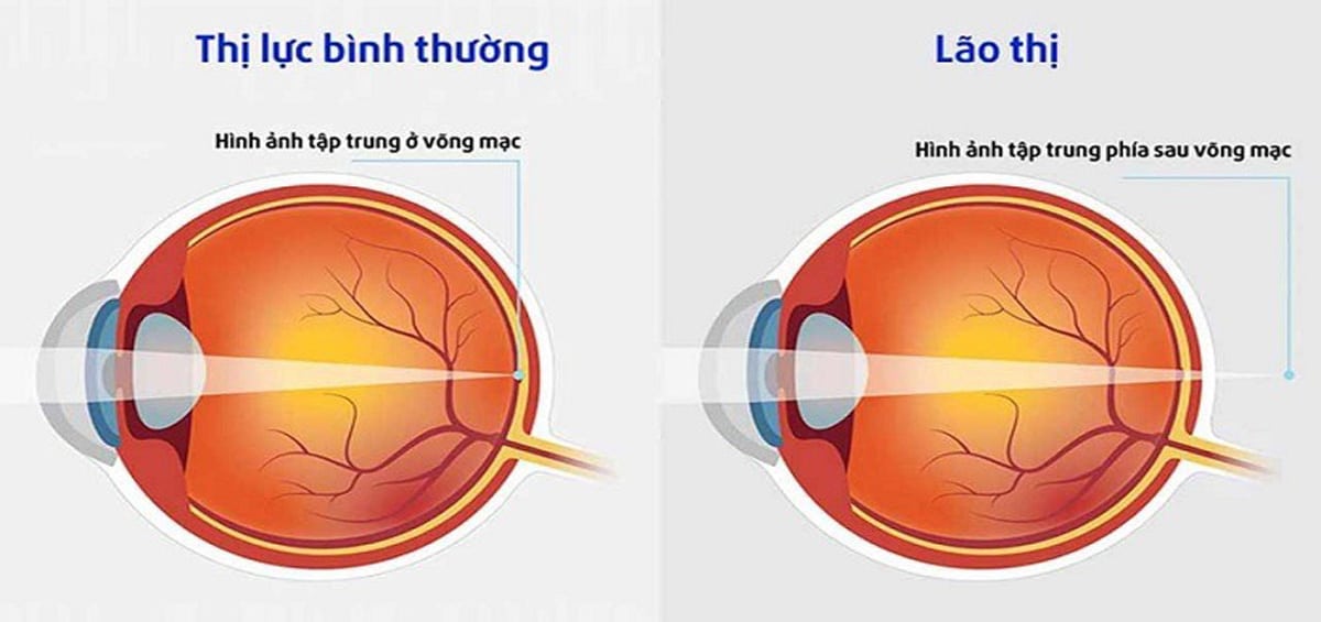 Lão thị là hệ quả tất yếu của tuổi tác