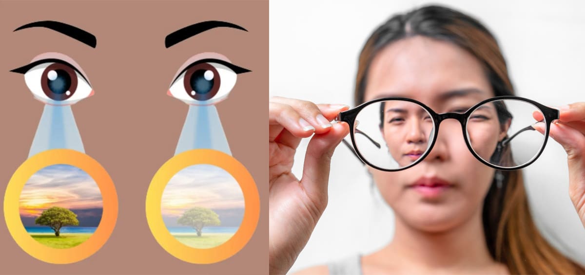Lệch khúc xạ mắt là gì