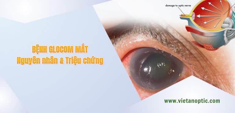 Glocom mắt - Nguyên nhân và triệu chứng
